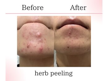 サロンツキ(salon tuki)/ハーブピーリング症例/徳島