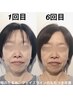 《初回体験》頬のたるみ、ほうれい線徹底改善　