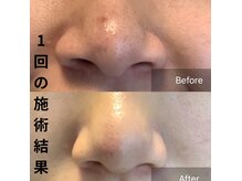 毛穴洗浄1回　角栓が気になる方はぜひ、お試しください