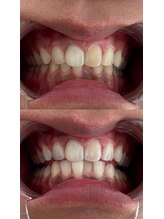 アレッド 大阪店(ared.)/ホワイトニング