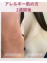 ララスマイル 鶴崎森町店/ガサガサ肌が綺麗になりました