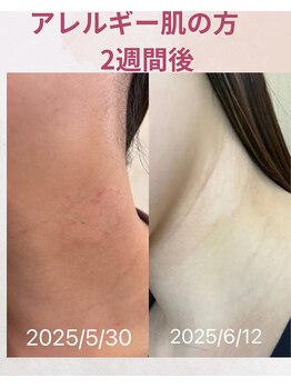 ララスマイル 鶴崎森町店/ガサガサ肌が綺麗になりました