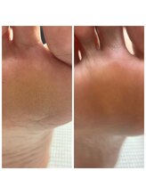 ドクターネイル爪革命 十条店/角質たこケア