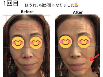 ベル/50代の方の小顔Before After
