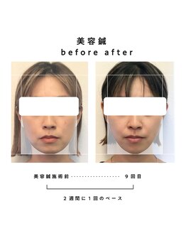 しらゆき堂鍼治療院/美容鍼Before After