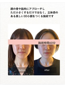 リノリー(rinory)/小顔コルギ
