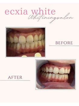 エクシアホワイトニング 倉敷店/ホワイトニングビフォーアフター
