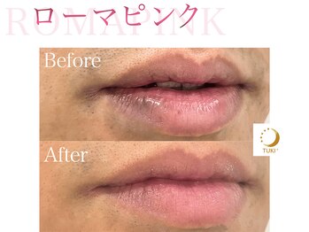 ツキ(TUKI+)/ローマピンク★全身の黒ずみ除去