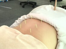 ふじ鍼灸整骨院/【鍼灸】腰痛の施術