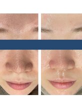 レベンディス(LEVENDIS)/毛穴洗浄