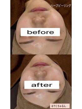 シロ(SHIRO)/肌質改善一度やると病みつき