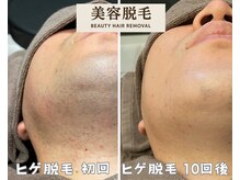 シエルエトワール 唐津店(Ciel Etoile)/美容脱毛　ヒゲ脱毛
