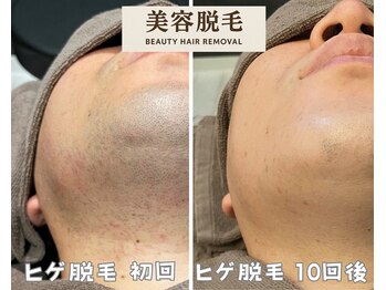 シエルエトワール 唐津店(Ciel Etoile)/美容脱毛 ヒゲ脱毛