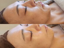 フリージア(Freesia)/シミケア＋ヒト幹フェイシャル