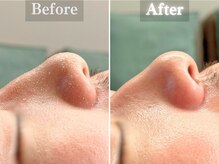 ボーンオム(Born Homme)/毛穴洗浄＋美容液導入：30代男性