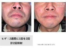 メン脱 三軒茶屋(Men脱)の雰囲気（人気No.1メニュー☆お客様に合わせた脱毛メニューをご提案します）