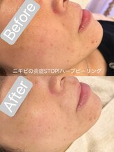 リンダ 西宮店(LINDA)/ニキビケア