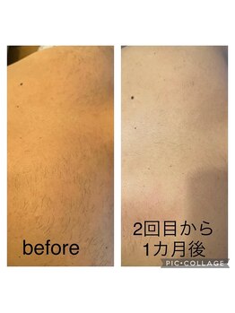 ウルル(Ululu)/【メンズ脱毛】背中脱毛2回目