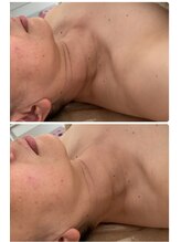 パーム(Palm)/若々しい首元に