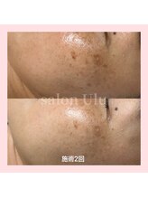 ウル(Ulu)/シミ、くすみ撃退！