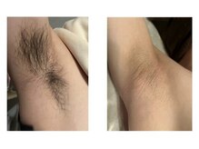 アンド エヌ(&n)/◆ワキ脱毛◆