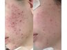 【化粧ノリUP】美眉デザインWAX×全顔艶肌フェイスWAX脱毛15000→12000円