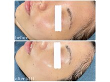 ちらちゅら/クリスティーナ【施術経過】