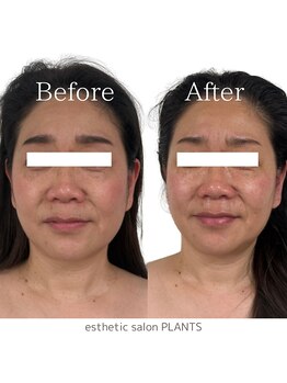 プランツ(PLANTS)/４0代／１回／くすみ・小顔