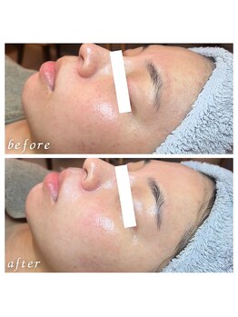 フィエルテ(Fielte)/小顔/艶肌/ピーリング