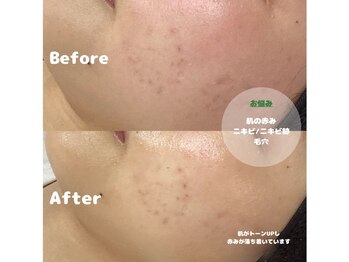 イース(ease)/お悩み別ハーブピーリング