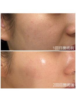 アデージョ アデオス(Ade-jyo.Adeosu)/【ホワイトスノウピール】