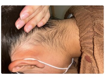 ベルフィオーレ(bel fiore)/10代女性 初回 Before