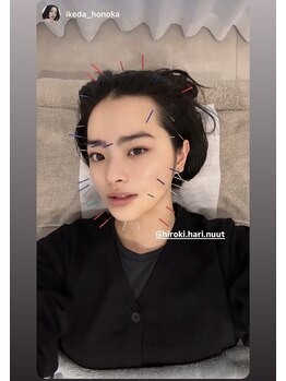 ニュート 表参道 外苑前(NUUT)/NUUT/ニュート/美容鍼/鍼灸/小顔