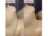 【二重顎・たるみ】脂肪分解レッドショット3cc×小顔矯正×EMS筋膜 ¥15,000