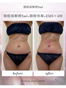 リリ(RIRI)の写真/【モニター募集中★】鹿児島でトップクラスの技術力◎スタッフが脂肪コントロールで短期スリムアップを☆