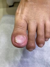 フットメンテ 巻き爪矯正センター 南浦和/肥厚爪　3か月経過