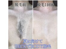 ベック(BECK)/全身から選べる脱毛★☆