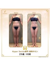 リンカ(Rinka.)/☆帯広初!!ハイパーナイフ導入☆