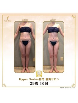 リンカ(Rinka.)/☆帯広初!!ハイパーナイフ導入☆