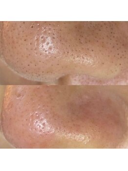 ジェリー(JERRY)/脱毛では無理だった、、