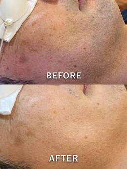 ジェンヌ(jenne.)/メンズ髭脱毛