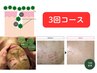 【Special★集中3回コース】ハーブピーリング＆ハイドラ毛穴洗浄＆ヒト幹細胞