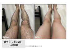 ザ エッセンシャル 碧南(THE Essential)/メンズ　脚脱毛