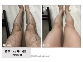 ザ エッセンシャル 碧南(THE Essential)/メンズ 脚脱毛