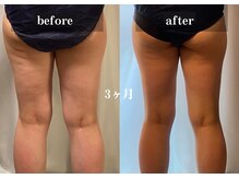 ダンデライオン 天神南店(dandelion)/痩身エステ3ヶ月