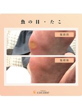 ココネ(cocone)/魚の目・たこ