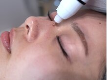 シミリセット 名駅(シミReset)/Step5.ピンポイントでシミ退治