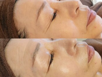 フリージア(Freesia)/　シミケア＋ヒト幹フェイシャル