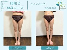 ボディコンディション/ウィンバック/痩身/小顔毛穴洗浄