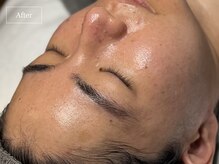 キュレイテッドスキン(CURATED SKIN)/ピーリング/毛穴ケア/肌質改善